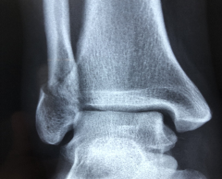 Elderly Bone Fracture Risk Prediction and Prevention: Artificial intelligence (AI) and Non/Minimally – Invasive Solutions 